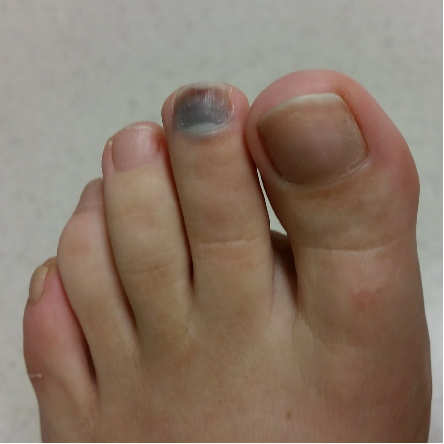 black toenail 2nd toe